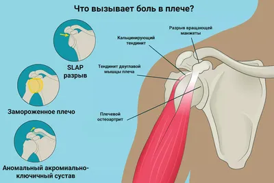 Разрыв мышцы плеча фотографии