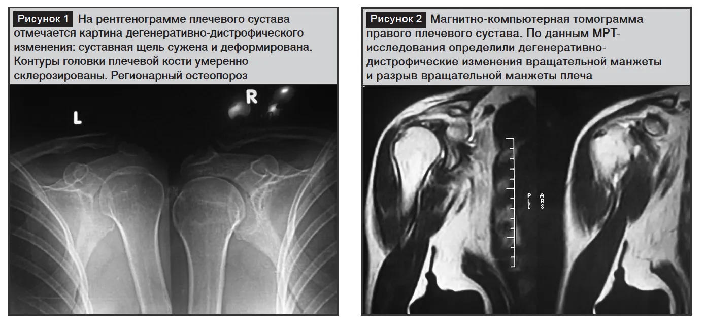 Мрт ключицы и плечевого. Травмы ротаторной манжеты плечевого сустава. Разрыв ротаторной манжеты мрт. Повреждение ротаторной манжеты плечевого сустава рентген. Сухожилия плечевого сустава мрт.
