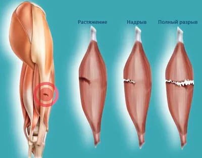 Разрыв мышцы фото