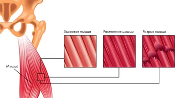 Напряжение и разрыв мышцы иллюстрация вектора. иллюстрации насчитывающей  разрыв - 62932917