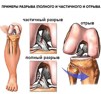 Повреждений мышц и сухожилий: симптомы, лечение в Москве