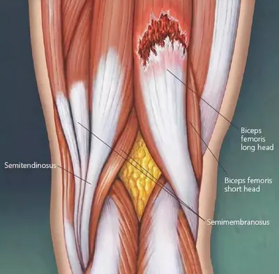 Сухожилия четырехглавой мышцы бедра (прямой мышцы): тенденит, растяжения,  разрывы – Лечение и восстановление – Отделение травматологии –  Государственная больница НКЦ №2 (ЦКБ РАН)