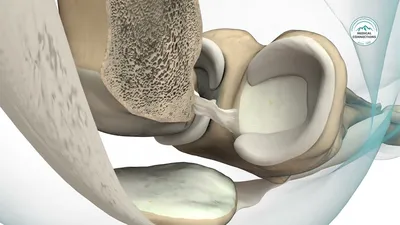 Лечение крестообразной связки колена, операции при разрыве пкс в клиниках  Германии