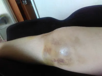 Вывих коленного сустава с разрывом связок | Пикабу
