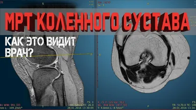 Разбор МРТ Коленного сустава. Что можно найти на снимке? - YouTube