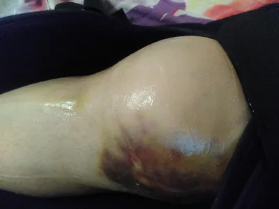Вывих коленного сустава с разрывом связок | Пикабу