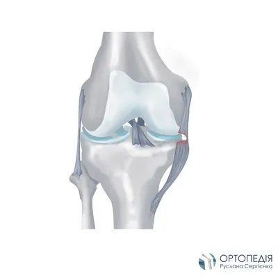 Лечение Повреждение боковых связок коленного сустава - Ортопедия Руслана  Сергиенко