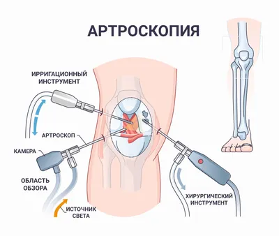 Артроскопия коленного сустава операция в СПб - сделать артроскопию колена,  цены
