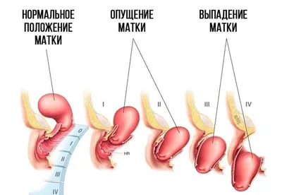 Опущение и выпадение влагалища и матки - Медицинский центр «ПОДМОСКОВЬЕ» г.  Жуковский