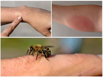 Аллергия на укусы насекомых, типы, реакции и методы лечения | Olvica