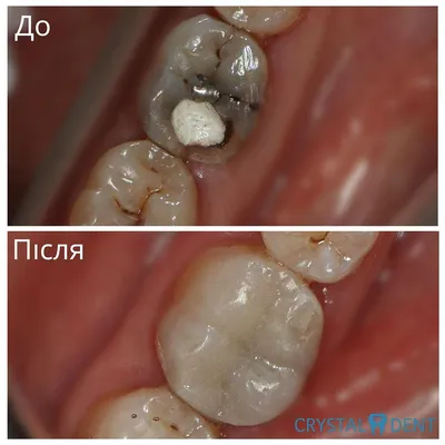 Реставрация шестого жевательного зуба - CrystalDent стоматология -  Голосеевский район Киева - Демеевская