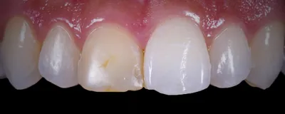 Реставрации зубов в Киеве 🦷 Цены на реставрирование зуба Дарница |  iStomatolog