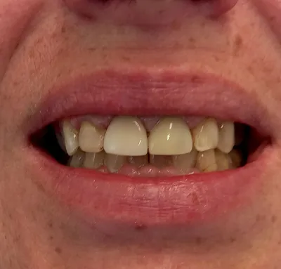 Реставрация 11-го зуба | Примеры работ - фото до и после