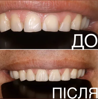 Художественная реставрация зубов в стоматологии Crystal Dent - Киев