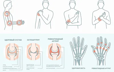 Артрит у детей - лечение детского артрита суставов, симптомы и причины