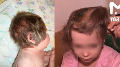 Московские врачи удалили 7-летней девочке гигантское родимое пятно на лице