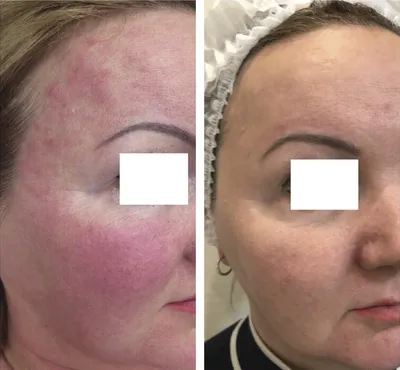 Фото до и после Лечение розацеа — Сеть косметологических клиник Эпилайк