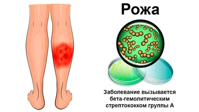 Рожа: лечение, патогенез, симптомы