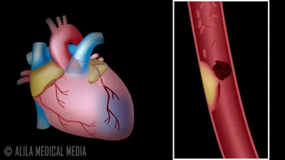 Рубец на сердце после инфаркта фотографии