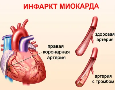 Лечение инфаркта миокарда в Екатеринбурге - Новая Больница