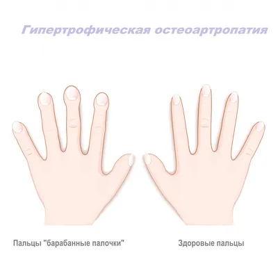 Боль в суставах кистей рук - причины появления, при каких заболеваниях  возникает, диагностика и способы лечения