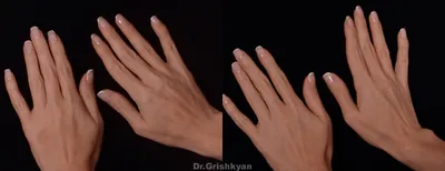 Липофилинг рук: фото до и после| Клиника доктора Гришкяна