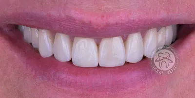 Самая красивая форма зубов фотографии