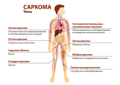 Саркома - kasvaja.net