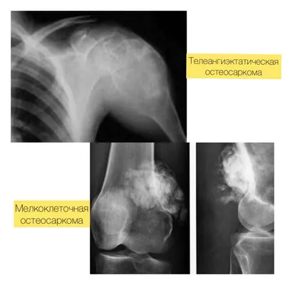 Остеогенная саркома кости у детей, симптомы, виды, диагностика и лечение