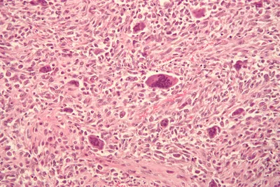 Остеогенная саркома — Википедия