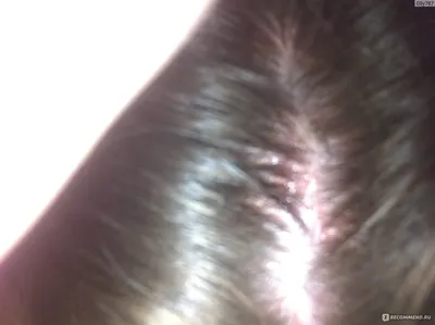 Противогрибковое средство Glenmark Антисеборейный шампунь Кето Плюс -  «Выпадение волос -это не шутки! Себорейный дерматит» | отзывы