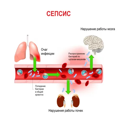 Сепсис - причины появления, симптомы и признаки заболевания, диагностика и  способы лечения, прогноз и последствия