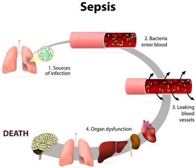 Сепсис