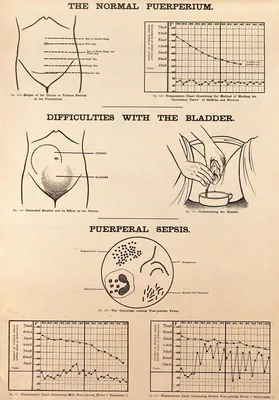 Нормальный послеродовой период, послеродовые затруднения с мочевым пузырем  и послеродовой сепсис. Литография по В.Ф. Виктору