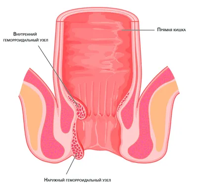 Наружный геморрой - причины и методы лечения