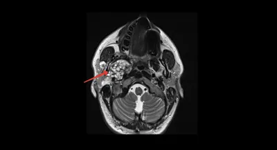 Плеоморфная аденома (карцинома) околоушной слюнной железы | Пикабу