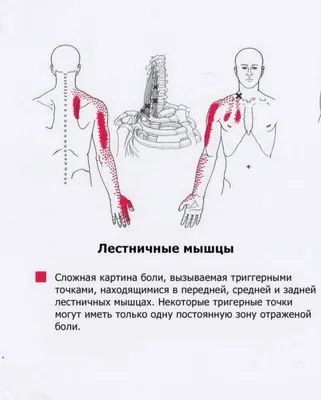 Синдром Передней лестничной мышцы или синдром Наффцигера » Спортивный  Мурманск