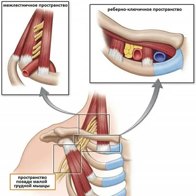 Синдром малой грудной мышцы (гиперабдукционныйй синдром Райта-Менделовича)