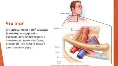 Синдром передней лестничной мышцы