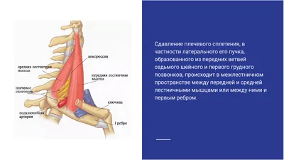 Синдром лестничных мышц (скаленус-синдром). Статьи