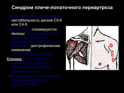 Синдром лестничной мышцы - online presentation