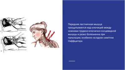 Синдром передней лестничной мышцы - причины, симптомы, диагностика, лечение  и профилактика