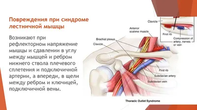 http://orthoclinic.kz/page/sindrom-lestnichnoy-myshtsy