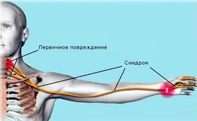 Синдром подключичного обкрадывания — Википедия