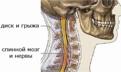 Синдром лестничной мышцы - Тандем-Мед