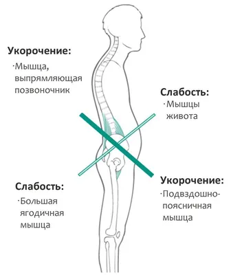 Синдром лестничной мышцы - презентация онлайн