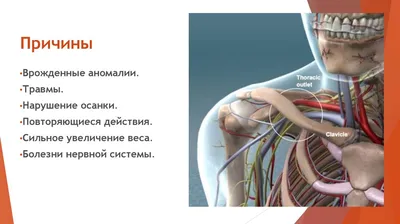 Остеопат, костоправ, Киев, Василий Панченко - 🔶Синдром лестничной мышцы  (еще называется скаленус – синдром) группа симптомов включающих в себя  боль, онемение и слабость в области шеи, плеча или руки. . 🔸Причиной  появления