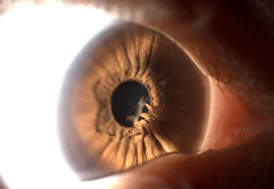▷ Что такое глазная синехия? - Área Oftalmológica Avanzada