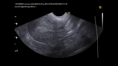 Внутриматочные синехии на УЗИ органов малого таза, несколько случаев -  YouTube
