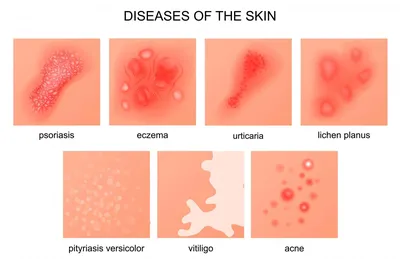 Дерматология в Бельгии - лечение заболеваний кожи за границей